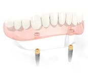 Implant-Supported Dentures in Detail, 3 of 3