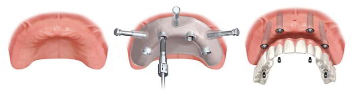 Implant-Supported Dentures in Detail, 1 of 3
