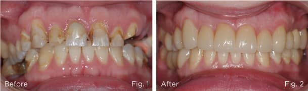 Composite before/after overview