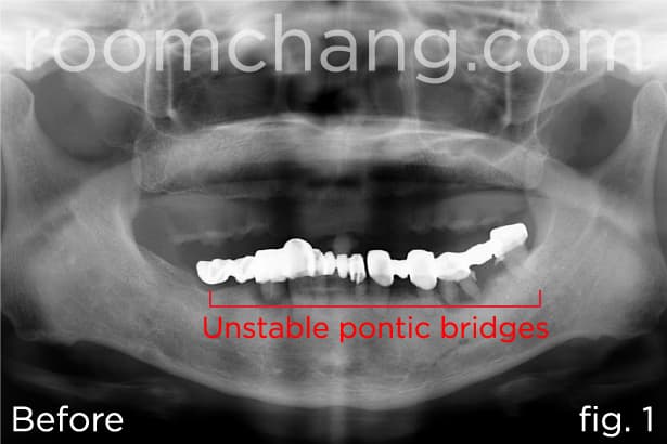 Before treatment — unstable lower bridge
