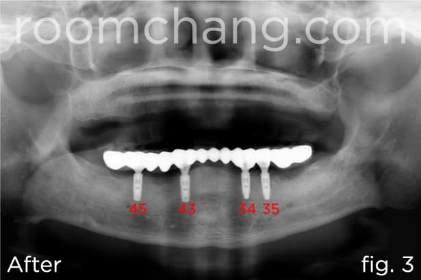 Lower arch — implant positions #34, 35, 43, 45