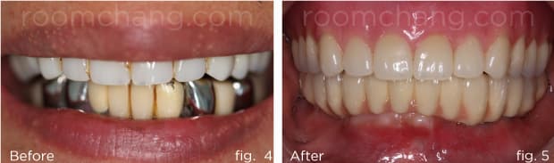 Final result — full upper denture and lower bridge