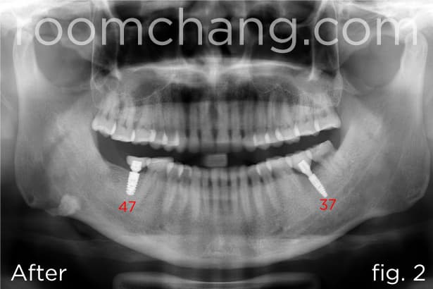 Clinical view — final crown placement