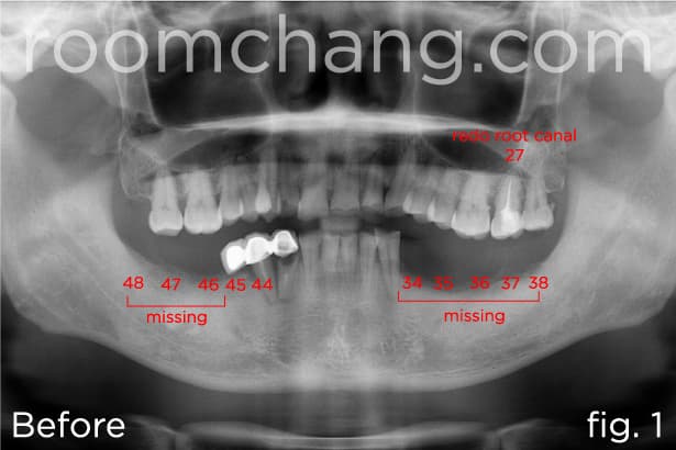 Before treatment — panoramic view showing missing teeth