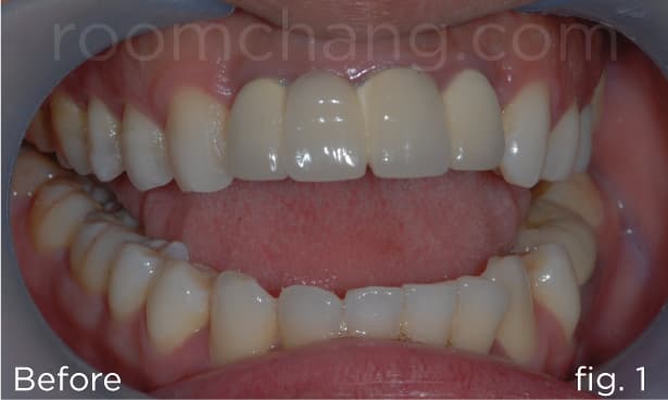 Before treatment — severe open bite and protrusion