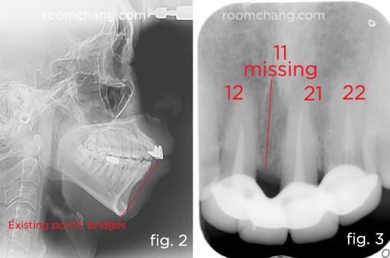 X-ray — before treatment
