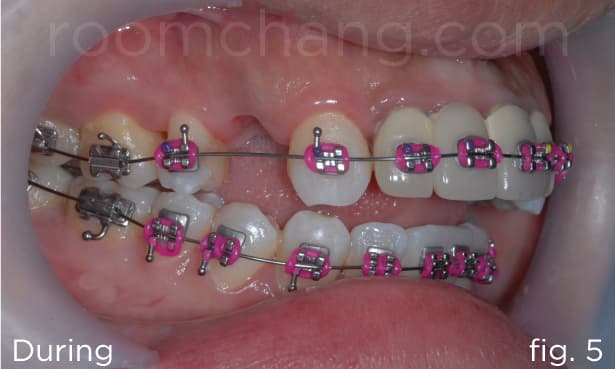 Progress — orthodontic alignment phase