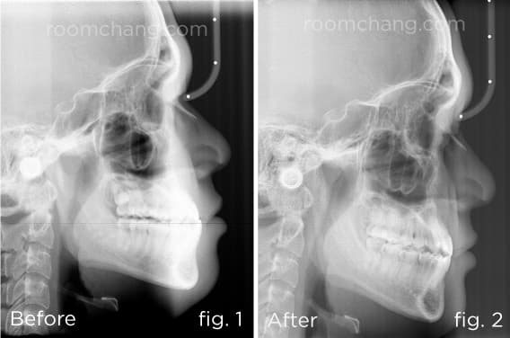 Cephalometric X-ray — before and after profile change