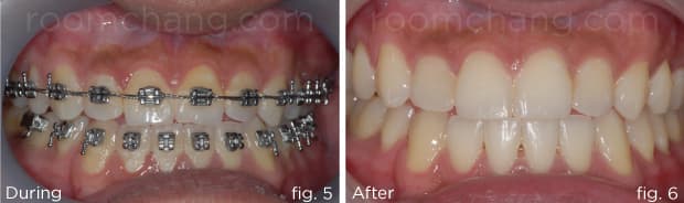 Dental alignment — after bilateral crossbite correction
