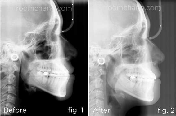 Profile view — before treatment