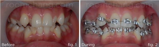 Before treatment — severe crowding and Class II malocclusion