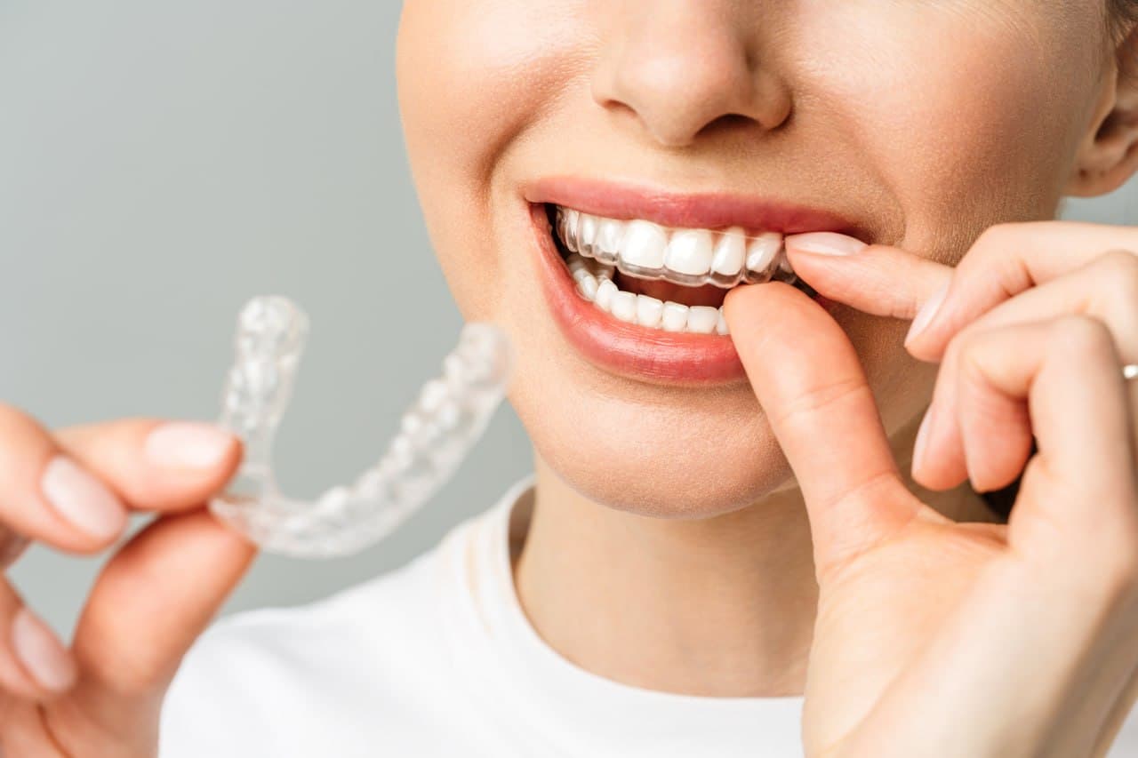 Orthodontic clear aligner treatment at Roomchang Dental Hospital