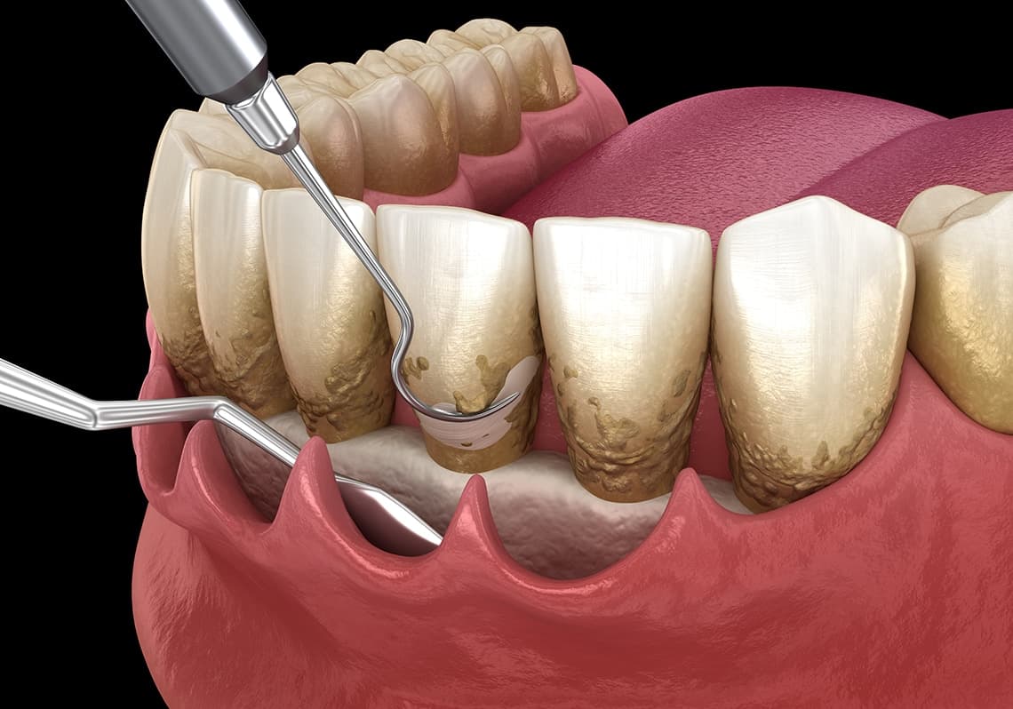 Periodontal Dentistry treatment at Roomchang Dental Hospital