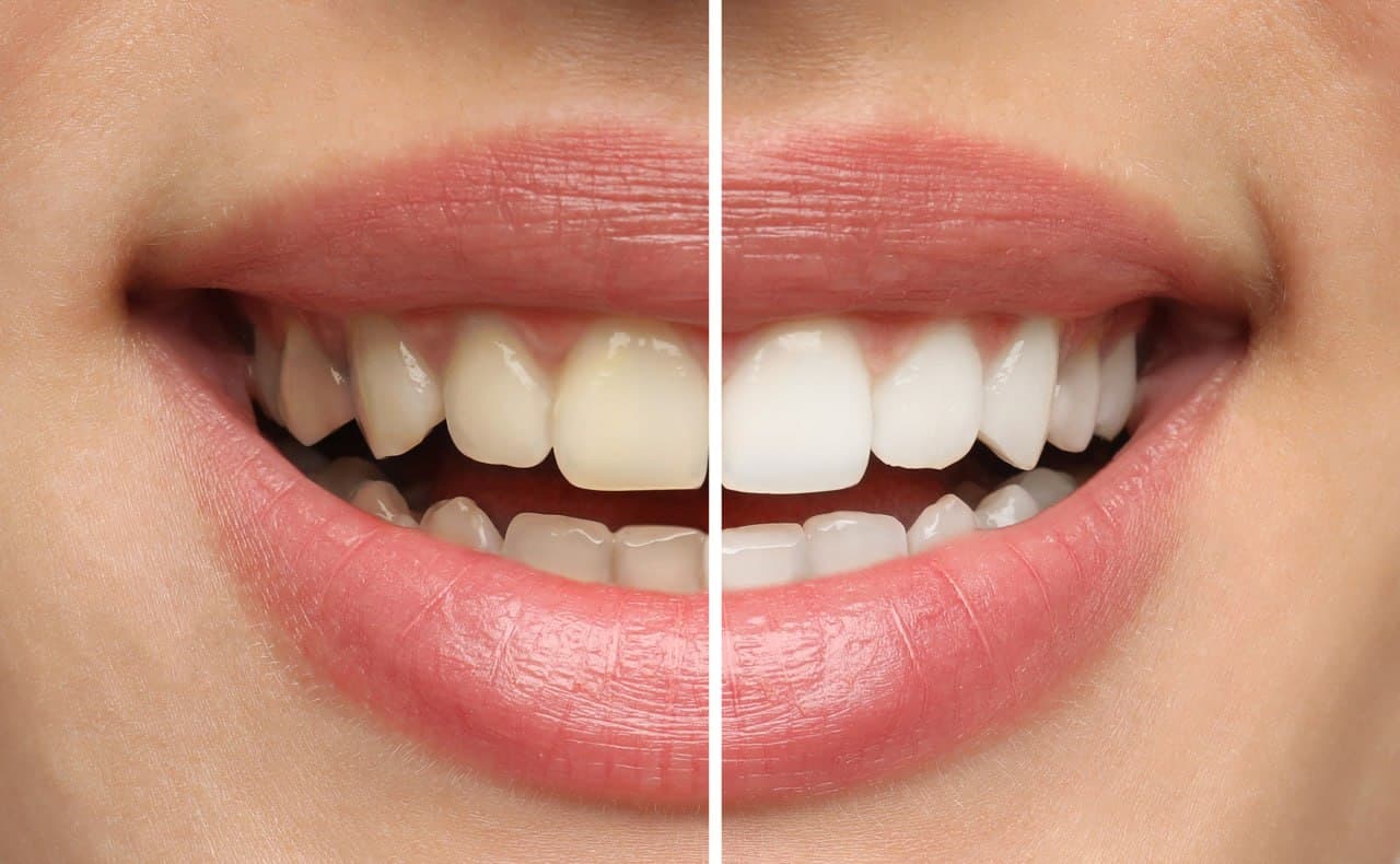 Teeth whitening treatment at Roomchang Dental Hospital
