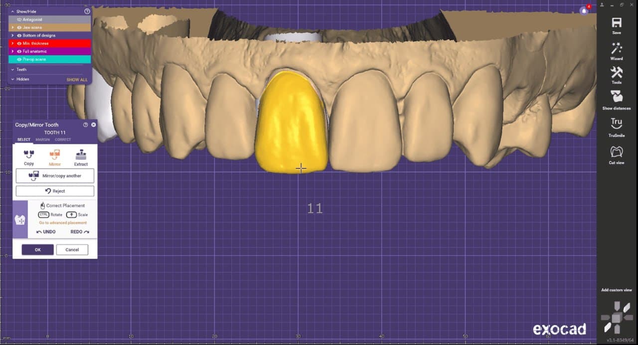 Exocad dental CAD software showing digital crown design for tooth restoration